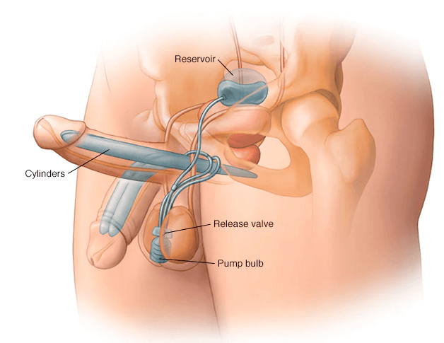 implant dla penisa jak osiągnąć stałą erekcję