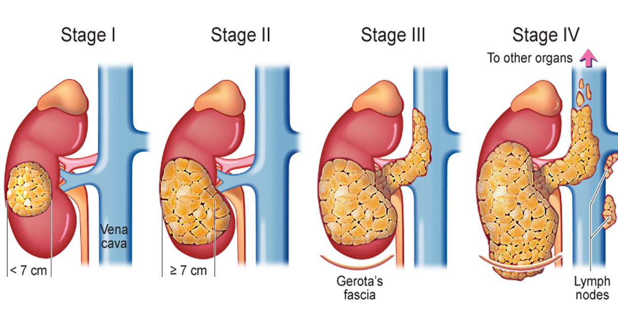 Different Stages of Kidney Cancer